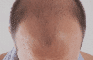 shampoo for hair loss