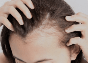 shampoo for hair loss